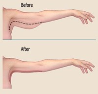 Full arm lift reduction