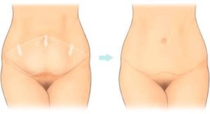 Tummy Tuck Abdominoplasty in Kenya | Dr Tilman Stasch | Vitality Fountain Clinic