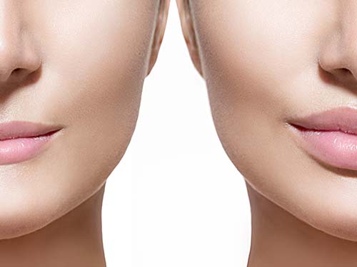 dermal fillers