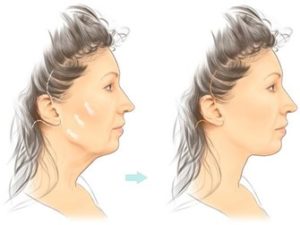 facelift surgery