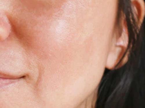 treatment of pigmentation