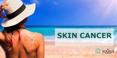 skin cancer