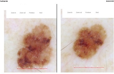 Mole Mapping Report 03