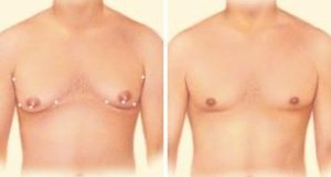 gynaecomastia surgery