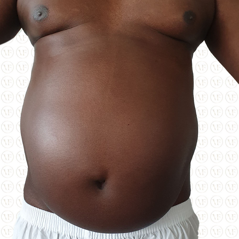 Liposutction 360 Male - Vitality Fountain Clinic