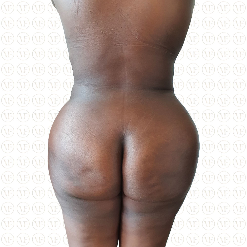 Kenyan Buttlift 360° Lipo- Vitality Fountain Clinic