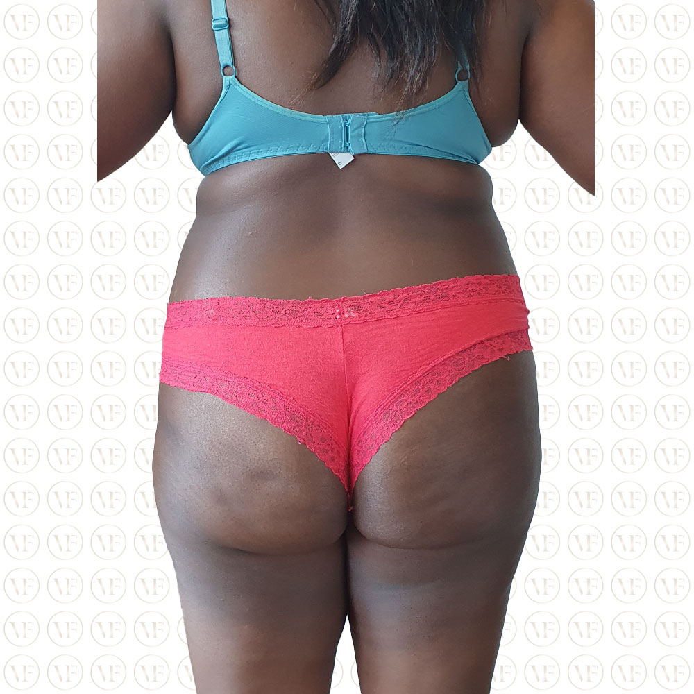 Kenyan Buttlift 360° Lipo- Vitality Fountain Clinic