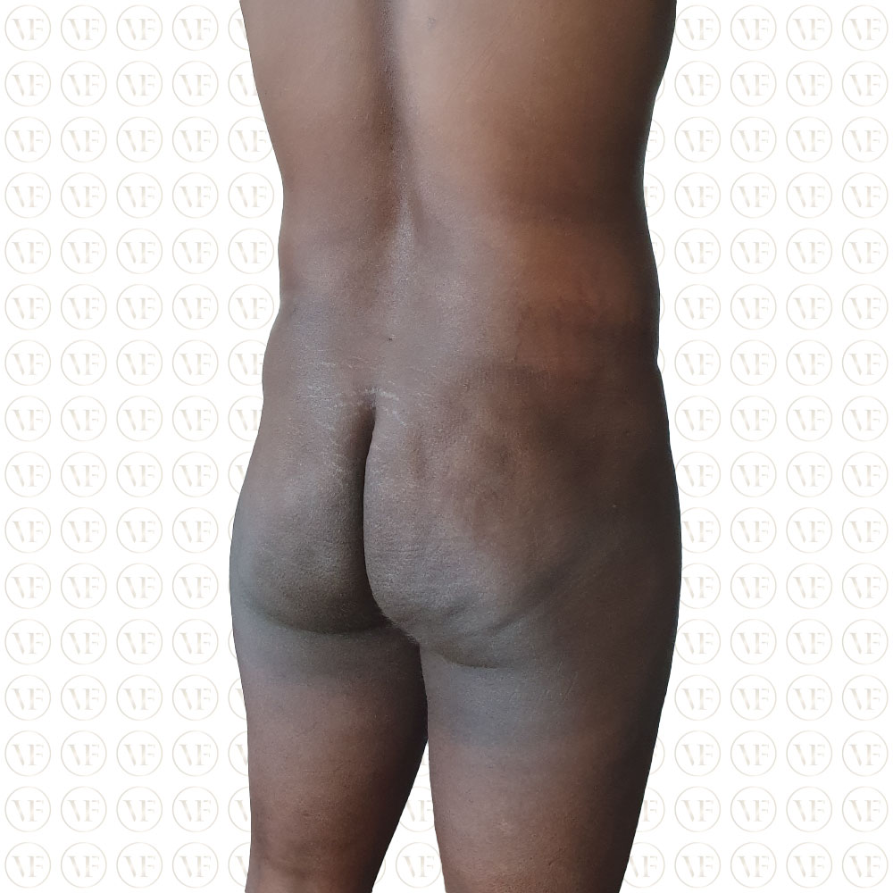 Liposuction Male Buttocks - Vitality Fountain Clinic