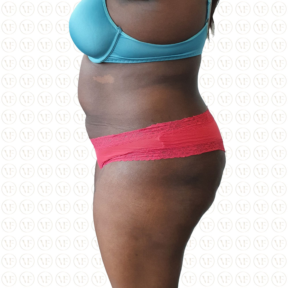 Kenyan Buttlift 360° Lipo- Vitality Fountain Clinic