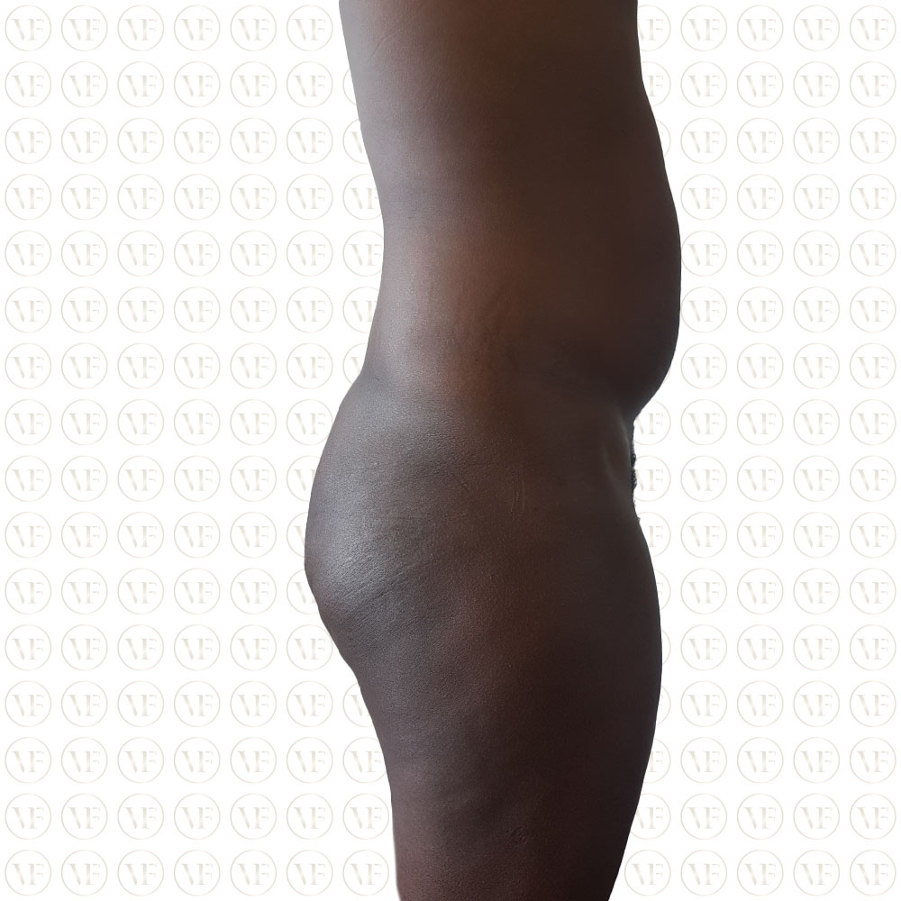 Liposuction Male Buttocks - Vitality Fountain Clinic