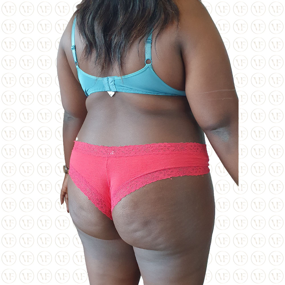 Kenyan Buttlift 360° Lipo- Vitality Fountain Clinic