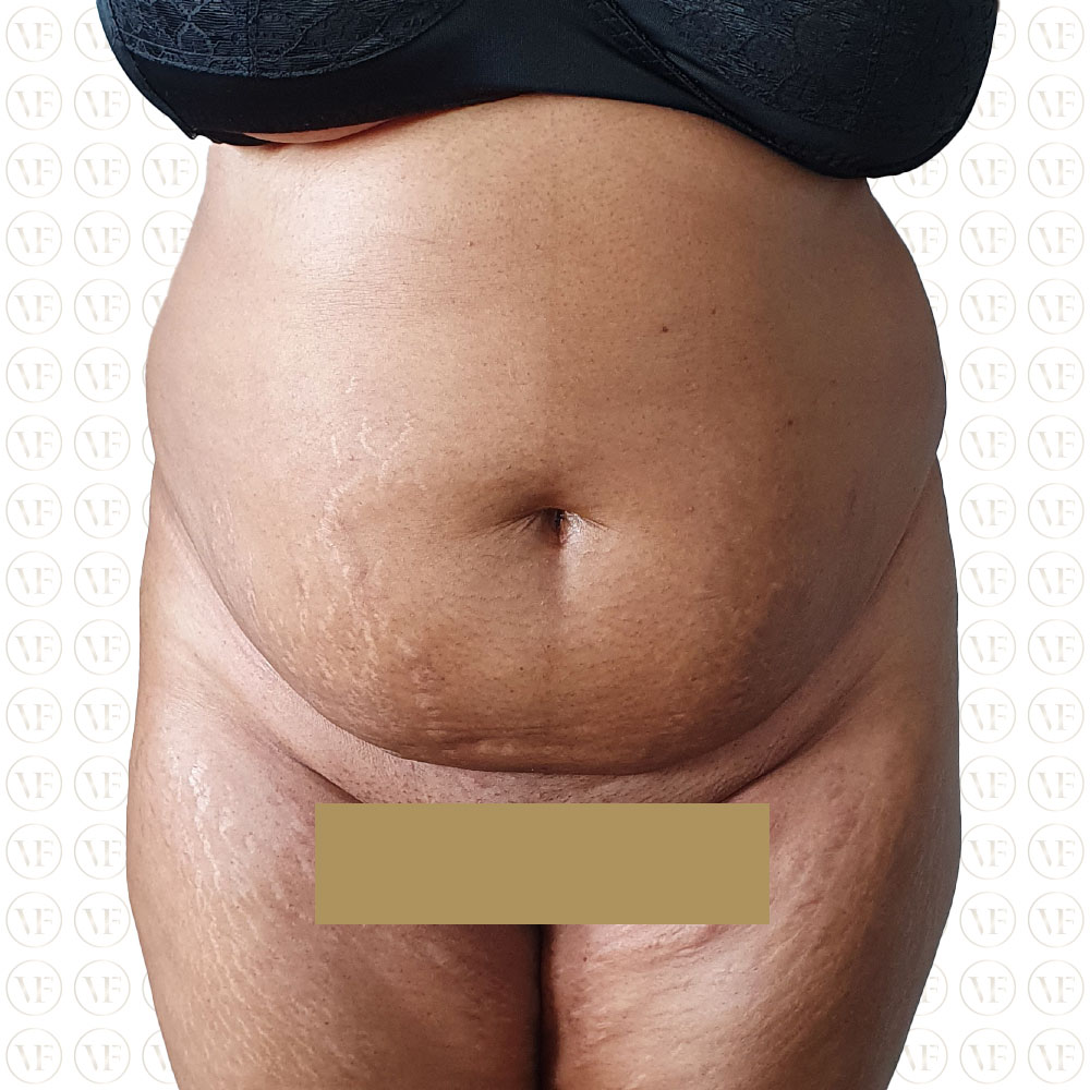 Kenyan Buttlift 360° Lipo- Vitality Fountain Clinic