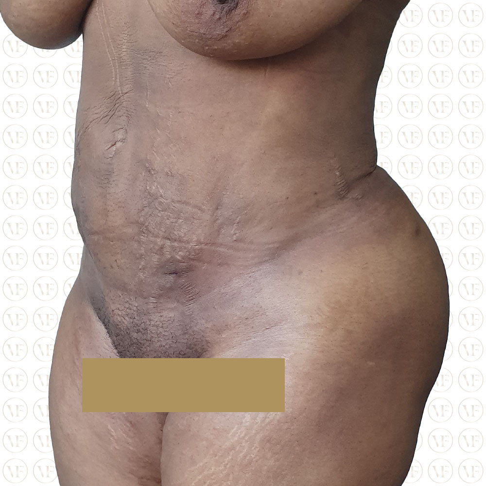 Kenyan Buttlift 360° Lipo- Vitality Fountain Clinic