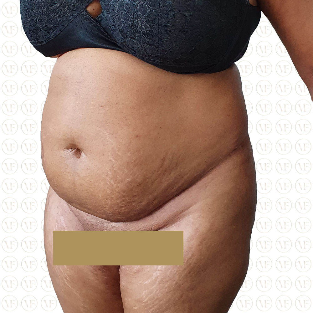 Kenyan Buttlift 360° Lipo- Vitality Fountain Clinic