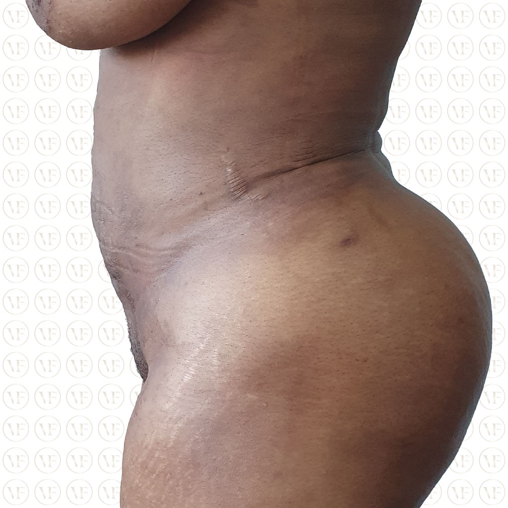 Kenyan Buttlift 360° Lipo- Vitality Fountain Clinic