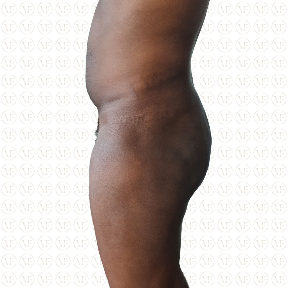 Liposuction Male Buttocks - Vitality Fountain Clinic