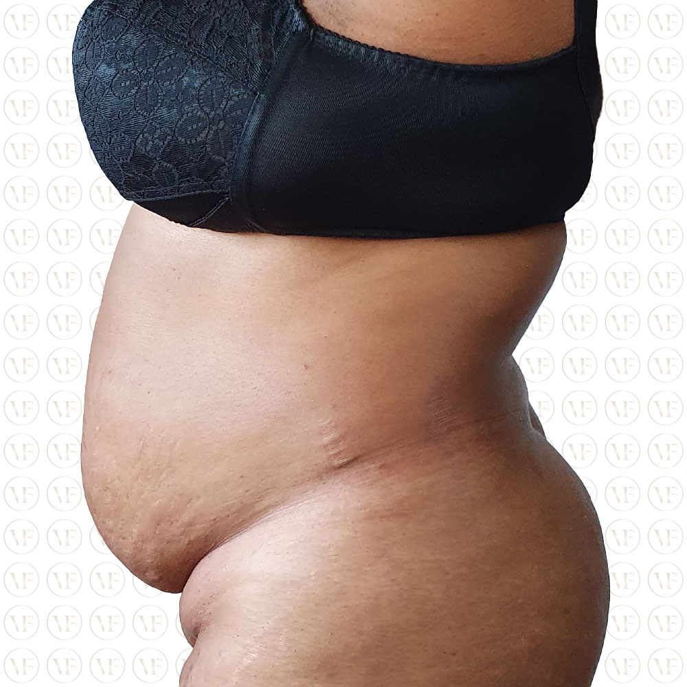 Kenyan Buttlift 360° Lipo- Vitality Fountain Clinic