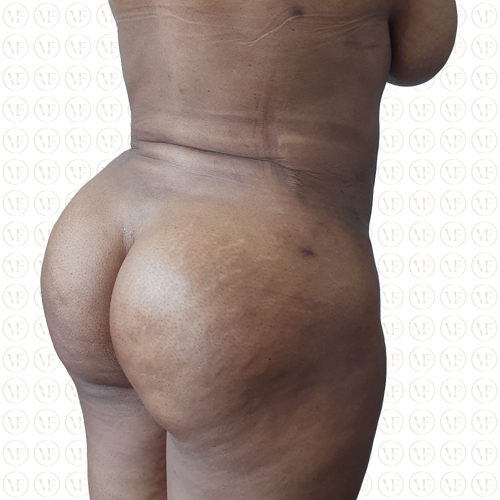 Kenyan Buttlift 360° Lipo- Vitality Fountain Clinic