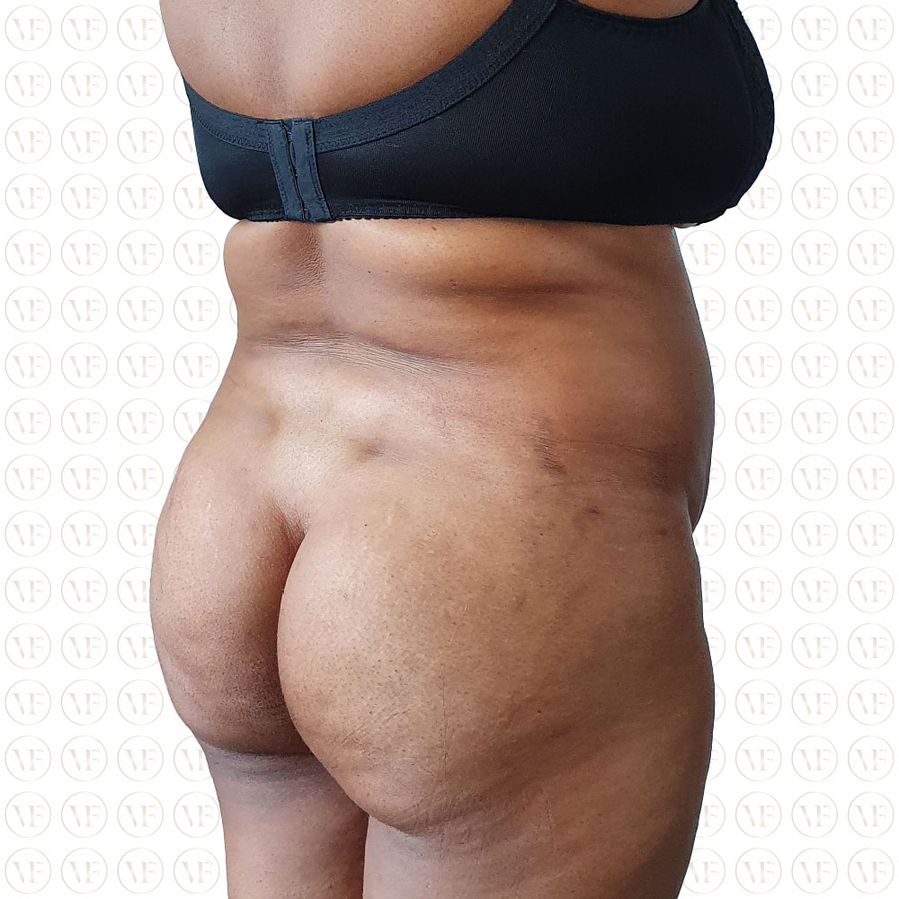 Kenyan Buttlift 360° Lipo- Vitality Fountain Clinic