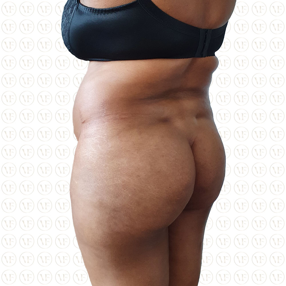 Kenyan Buttlift 360° Lipo- Vitality Fountain Clinic