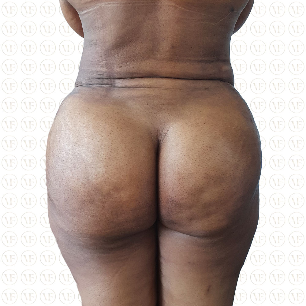 Kenyan Buttlift 360° Lipo- Vitality Fountain Clinic