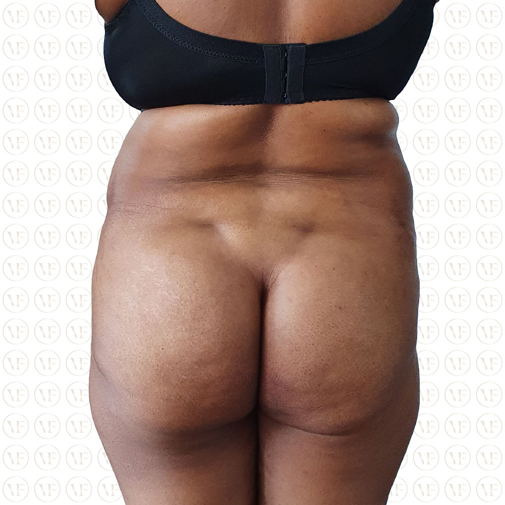 Kenyan Buttlift 360° Lipo- Vitality Fountain Clinic